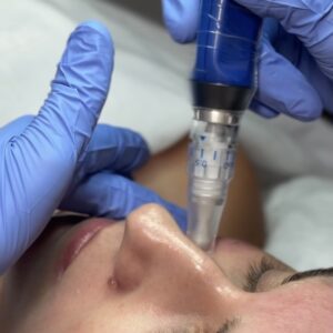 SkinPen™/Microneedling Micro Therapy